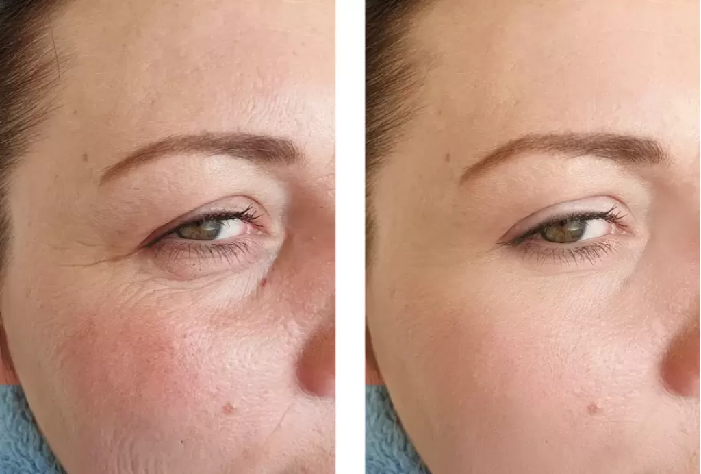 Before and after photo of a smiling woman in her 40s. The before photo shows her with a rounder, fuller face. The after photo shows a slimmer, more contoured facial appearance with a defined jawline.